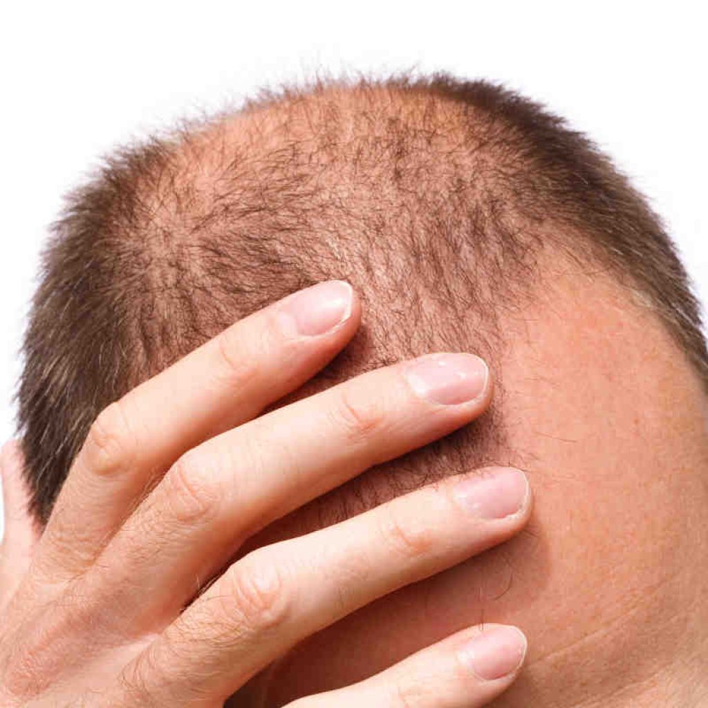 Hair loss